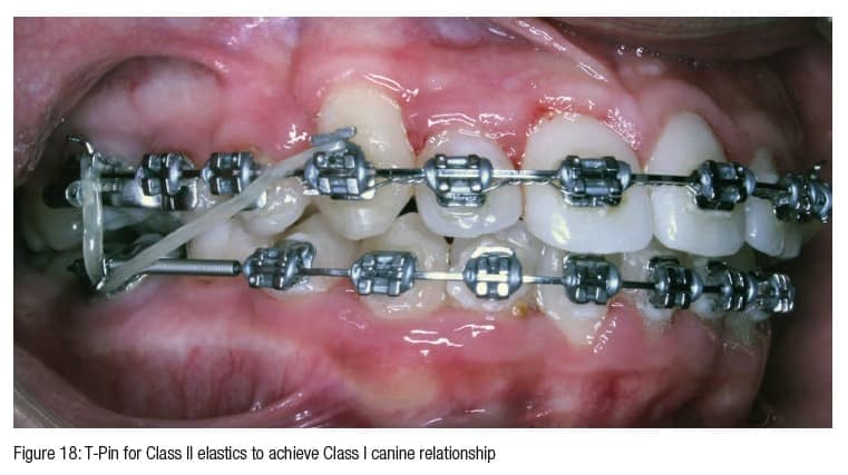 Orthodontic CE Article - Vertical slot brackets — for increased treatment  efficiency