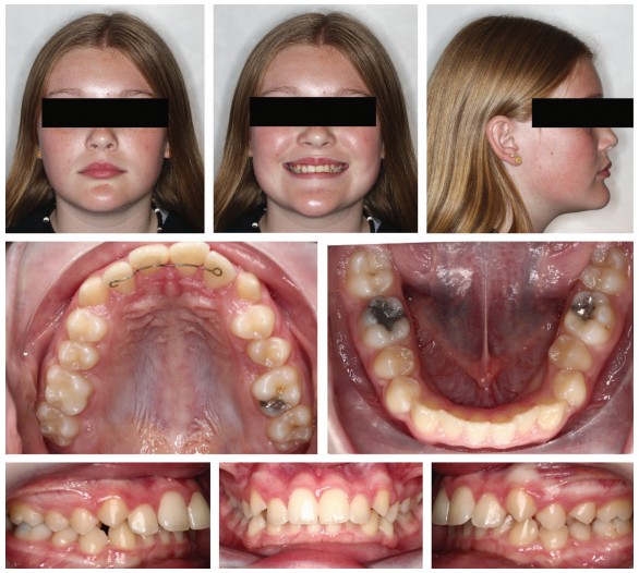 Braces – Non-extraction Straightwire Technique - Non-Extraction Orthodontics