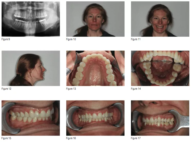 ClearCorrect™ correction of a Class I impinging deep bite with