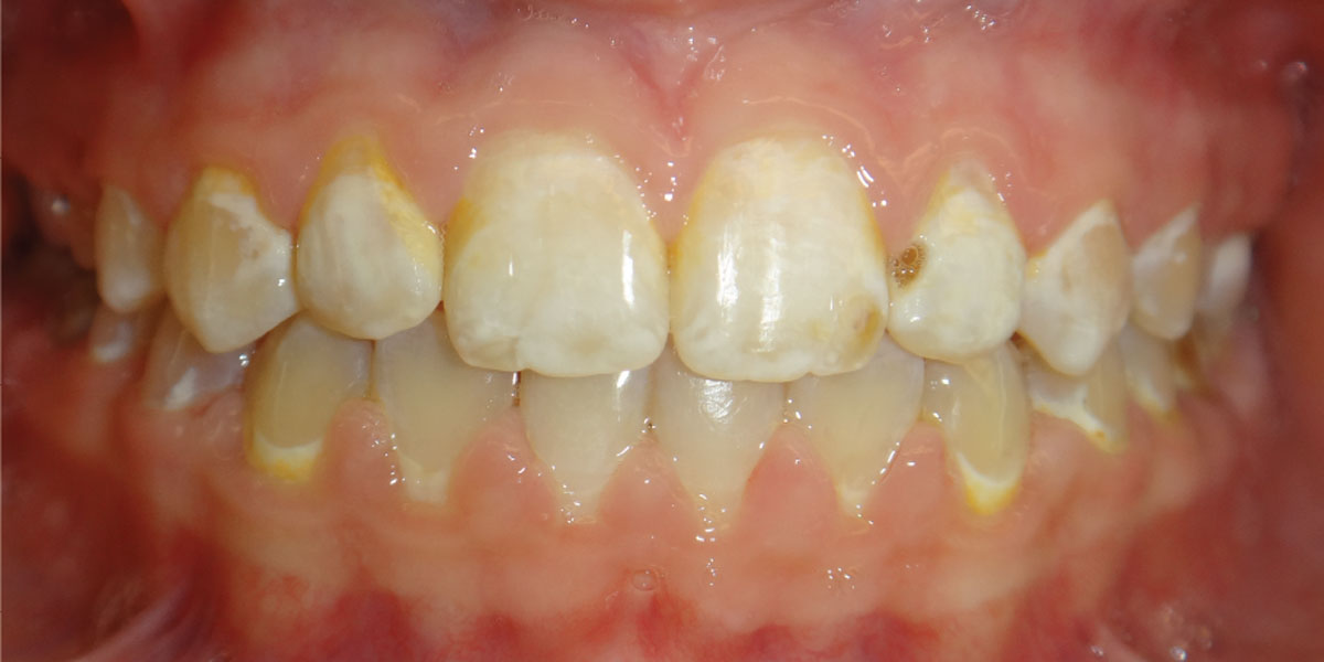 An orthodontic perspective on white spot lesions: part 2 ...