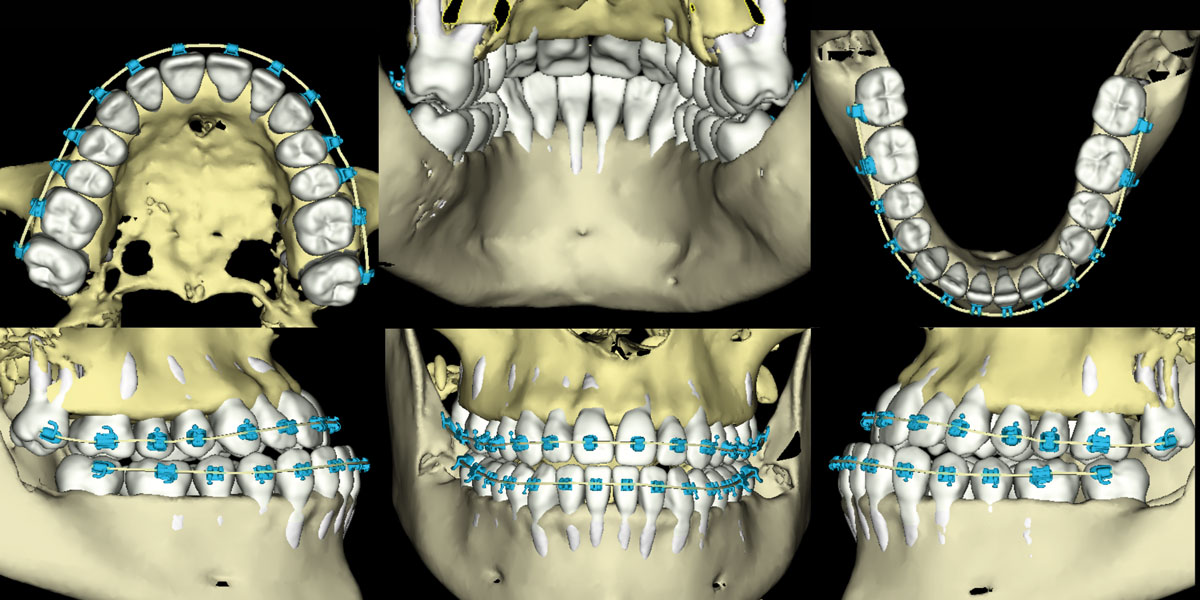 biodigital-orthodontics-management-of-skeletal-deformities-with