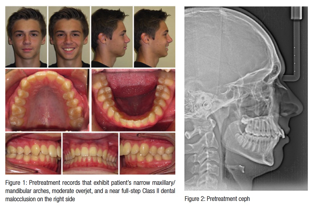 Treatment Of Asymmetrical Class Ii Malocclusion Orthodontic Practice Us