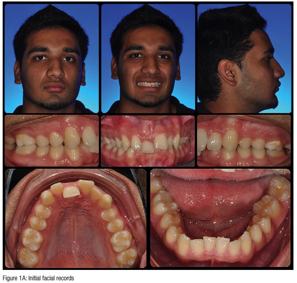 class ii div i occlusion