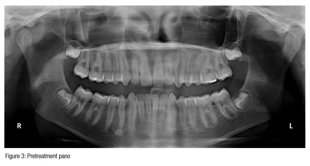 figure3-bovenizer