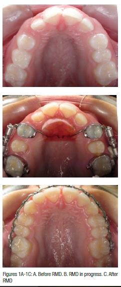 Controlled molar distalization before after 6V6N