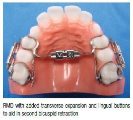Controlled molar distalization transverse expansion 6V6N