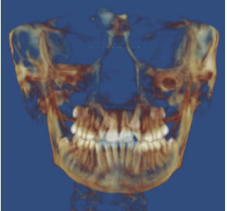 Figure 11: The exact same technique was used — PDS prescription, 20/20 molar, .018 HANT, gold chain 