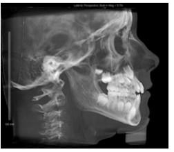 Figure 2: Cervical vertebrae with no spacing