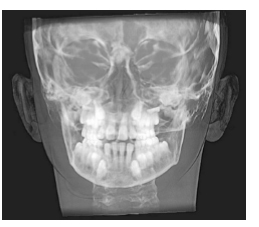 Figure 3: Maxillary asymmetry — left side lower