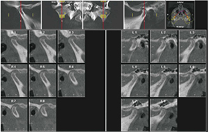 Figure 4: Significant DJD right condyle 