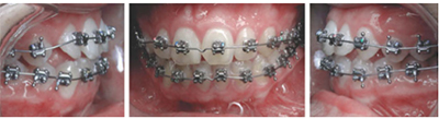 Figure 7: Placement of brackets with 20/20 molar. No elastics, open coil springs, TADs, or co-ligation of teeth were ever used. Space was made by using a large NiTi wire (.018), causing rotation of maxillary right first molar and friction/binding. After 10 weeks, the impacted canine (labial) was ligated, and the wire placed through a link on the gold chain 
