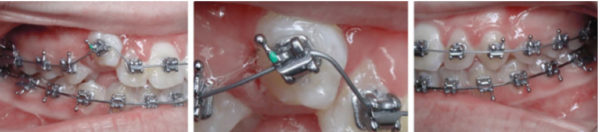 Figure 9: Six weeks later, the tooth was erupted and was bonded 