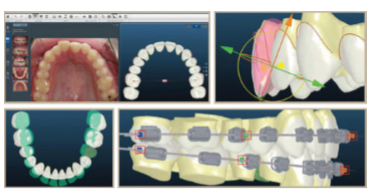 Insignia™ Advanced Smile Design™ allows orthodontists to combine their treatment preferences with the precision of computer-aided smile design 