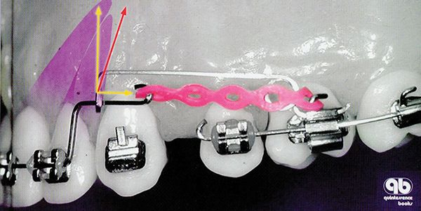 The Biomechanical Foundation of Clinical Orthodontics Orthodontic