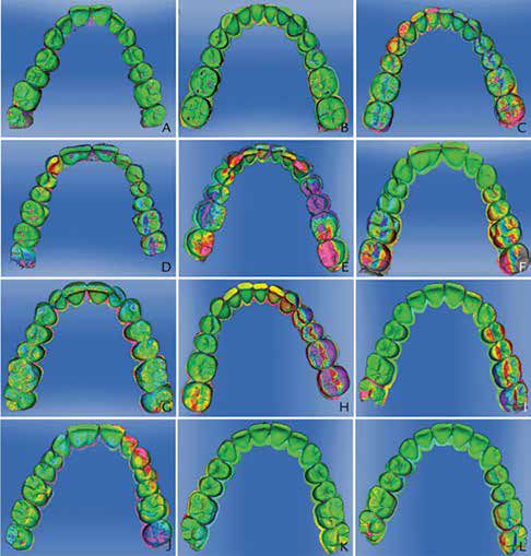 Figure 1: Difference pattern between repeated impression (precision); color graded from -100 μm (purple) to +100 μm (red). A. VSE. B. VSES. C. VSES-D. D. POE. E. ALG. F. CER. G. OC. H. LAV. I. T-Def. J. ITE. K. TRI. L. TRC