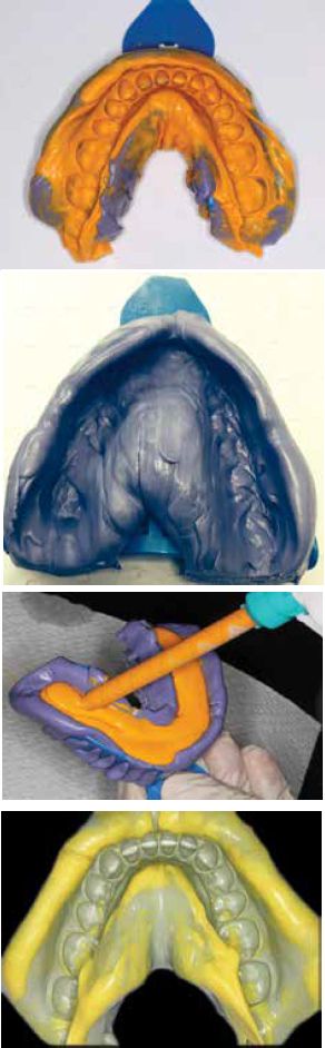 (Top to bottom) Figure 2: All aspects of a quality impression are represented here. Capture of all critical data in light body, no tears or drags, and adequate extension Figure 3: Putty base with good extension into sulcus and occlusal anatomy obliterated Figure 4: PVS light body material (SAM, EOCA USA) being carefully loaded into putty base to ensure no introduction of bubbles Figure 5: One-stage impression technique yields poor accu- racy as light body (yellow) has been forced into peripheral areas by the putty material
