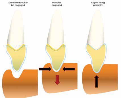 Figure 6: Cross-sectional representation of anatomically shaped visco-elastic acceleration and seating device (Munchies) capturing a significant section of the aligner and returning forces