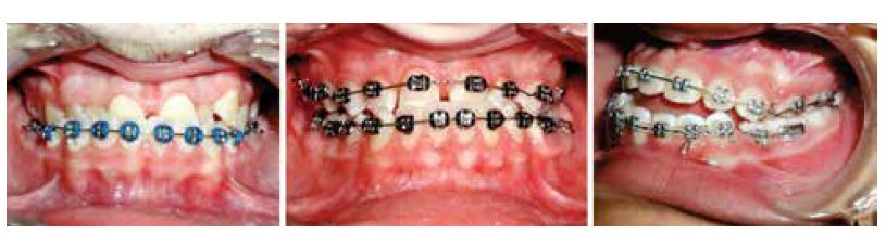 Figures 2A-2C: 2A. Bonded mandibular teeth in the alignment stage with blocked-out maxillary incisors. 2B. Initial aligning 0.016" round NiTi wires with intrusive V-bends. Note the amount of incisor intrusion evident in the distance between mandibular incisor edges and maxillary incisor brackets. 2C. A lateral intraoral view showing the extent of intrusion achieved by the V-bends for the maxillary and mandibular anterior teeth disengagement. It shows the ongoing mandibular incisor retraction into the first premolars’ extraction spaces