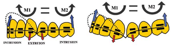 Figures 3A-3B: 3A. Diagram showing analysis of the force system created by V-bends located between canine and first premolar teeth. Note the long range of NiTi archwires’ activation of the V-bend before tying it in anterior teeth brackets. To bring the system into equilibrium, the anterior apically directed intrusive force on the incisors results in a moment M1, which must equal the intrusive force-creating moment acting on the terminal molar M2. 3B. Shows the effects of the force system, i.e., incisor and molar intrusions and extrusive forces acting on canine and first premolar located adjacent to the V-bend