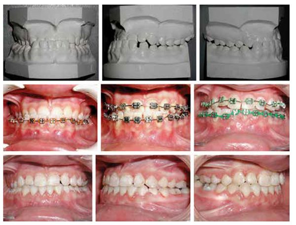 Patient 1: Top row: Pretreatment models of a 15-year-old female patient with a molar and cuspid relations Class III malocclusion complicated by bilateral crossbites. Note existing interdental spaces existed in the mandibular canine areas that provided space for incisor retraction without premolar extraction. Middle row: Shows mandibular teeth bonded with 0.016" NiTi wire and intrusive V-bends. The mandibular incisors intruded enough to bond the maxillary teeth without a bite-raising plate. Later, simultaneous intrusive V-bends were placed on both arches with 016" x .022" NiTi archwires, which disengaged the anterior teeth while the mandibular incisors were retracted with an elastic chain. It is crucial to continue the V-bends in the mandibular archwire during anterior retraction to avoid mandibular incisors’ root dehiscence. Also note the transverse-oriented V-bend in the maxillary midline that expanded maxillary molars and corrected the posterior crossbites. Bottom row: Post non-extraction treatment intraoral photographs showing a normal overbite, overjet, and Class I molar/cuspid relations with a correction of the bilateral posterior crossbites