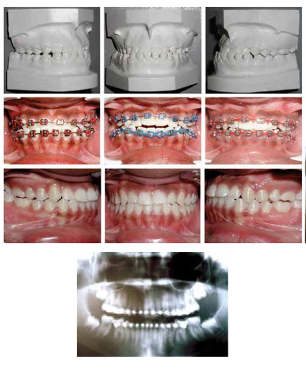 Patient 2: Top row: Pretreatment models of a 14-year-old female patient with a Class III malocclusion complicated with a right side posterior crossbite. Middle row: shows the alignment and intrusion stages with maxillary and mandibular V-bends (right) that accomplished incisor disengagement and the beginning of mandibular incisors' retraction (middle). Mandibular and maxillary 0.016" x 0.022" NiTi archwires restore proper overjet and overbite (left) just before repositioning maxillary incisors' brackets for the finishing stage. Bottom row: Shows posttreatment photos with normal overbite and overjet, Class I molar/cuspid relations, and corrected crossbite. The panoramic radiograph before debanding shows no root resorption from using this V-bend technique 