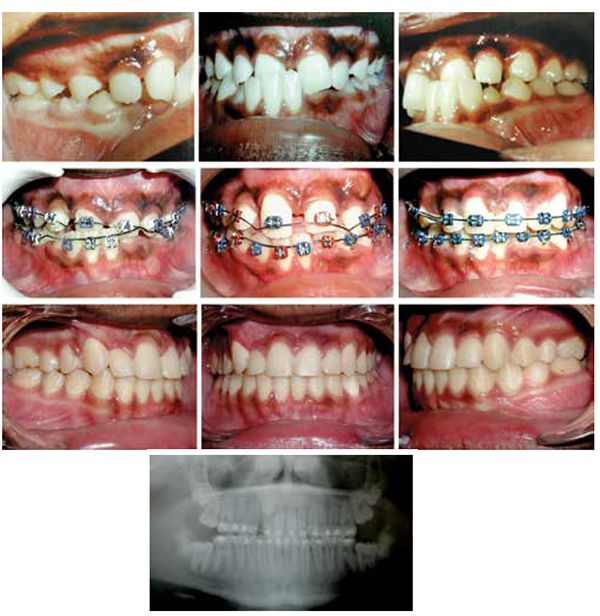Patient 3: Top row: Pretreatment intraoral photographs of a 14-year-old male patient with an interlocking incisal Class III malocclusion and Class I molars. Middle row: 0.016" NiTi aligning maxillary archwires with V-bends between maxillary incisors. Also, 0.016" x 0.022" NiTi archwires with V-bends, tucked occlusally to affected maxillary and mandibular incisor brackets’ tie wings to maximize incisors intrusion, disengagement, and subsequent retraction. Note opening spring on the maxillary wire to open space for an unerupted maxillary right canine. Also note restoration of normal overbite and overjet relations. Bottom row: Final intraoral nonextraction treatment photographs with normal overbite, overjet, and Class I molar/cuspid relations. Note the improved gingival level of the previously traumatized mandibular incisors. The panoramic radiograph shows no sign of root resorption from this technique 