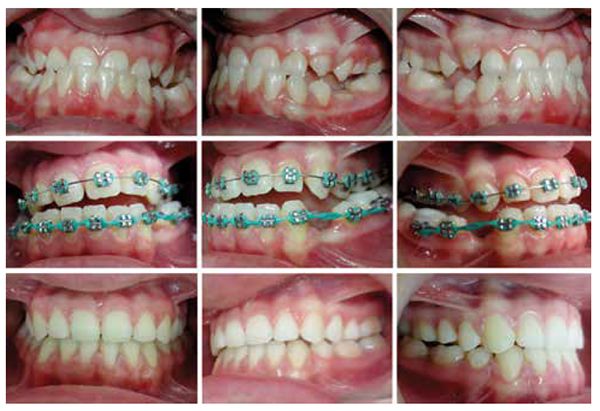 Patient 6: Top row: Intraoral photos of a 6 ft. 5" tall, 12-year-old female (one of twins), with a severe dental and skeletal Class III malocclusion complicated by bilateral posterior skeletal crossbite and maxillary deficiency. Parents declined a surgical option and requested only orthodontic treatment, with mandibular first premolar extractions. Middle row: Composite build-ups on the mandibular molars allowed simultaneous bonding of maxillary and mandibular dental arches. After alignment, maxillary and mandibular .016" x .022" NiTi archwires with intrusive V-bends were placed, and mandibular incisors were retracted into the extraction spaces while incisors were disengaged. Mandibular incisor retraction and space closure continued until the overjet was corrected. Expanding maxillary and constricting mandibular rectangular NiTi archwires and subsequent stainless steel rectangular archwires with the composite build-ups were in place to unlock molar cusp interference and facilitated posterior crossbite correction. Treatment time was 3 years. The finishing stage used Class III and posterior bite-closing elastics to consolidate the occlusion. Bottom row: Posttreatment intraoral photos achieved, despite pubertal mandibular growth of this patient that complicated the corrective measures and lengthened the treatment time