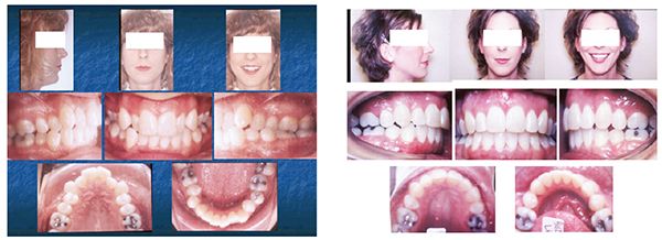 (Left to Right) Figure 5: Adult Class II malocclusion; Figure 6: Occlusal result of maxillary first and mandibular second pre-molar extractions.