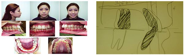 Left to Right: Figure 7: Mature adolescent patient with a Class II malocclusion; Figure 8: VTO illustrating needed movement of the incisors.