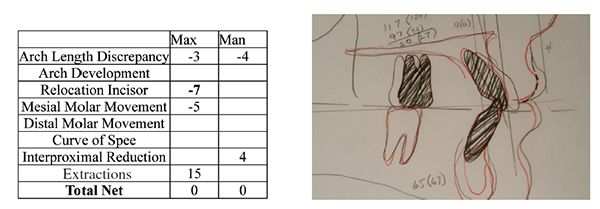 (Left to Right): Figure 9: Modified Steiner box for calculating space needs of this patient; Figure 10: VTO superimposed on the actual treatment result.