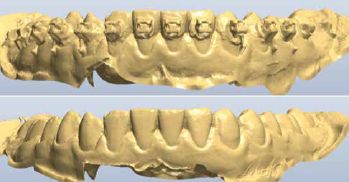 Before and after bracket removal and scan cleanup.