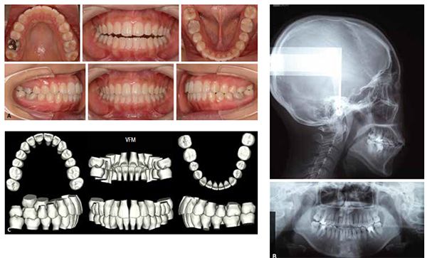 Figure 13: Patient S.N. One week later, the patient was debonded 13A. Final intraoral photos taken at debond 13 weeks post suresmile wire insertion and 7 months from start of treatment. 13B. Final X-rays. 13C. Virtual Final Model (VFM)