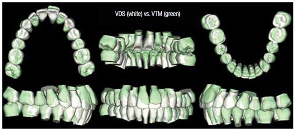 Figure 6: Patient S.N. Superimposition of the VTM against the VDS shows that the planned archwidth was achieved with Quadhelix appliances in both the upper and lower arches