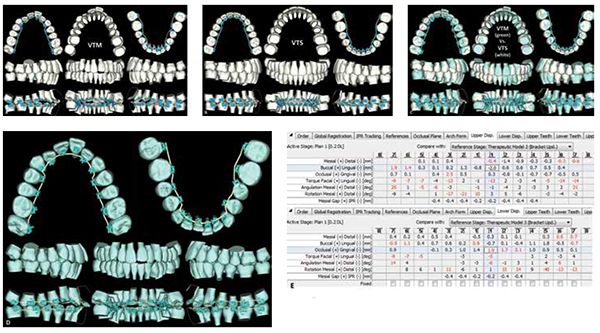 Figures 7A-7E: Patient S.N. 7A. Virtual Therapeutic Model (VTM). 7B. Virtual Target Setup (VTS) with suresmile precision archwire designed. 7C. VTS (white) vs. VTM (green). 7D. Suresmile precision archwire viewed against VTM. 7E. Planned orthodontic tooth displacements