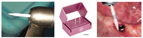 (Left to right) Figure 3: CeraTipTM in an air turbine handpiece Figure 4: CeraTipTM Kit Figure 5: Exposure of implant