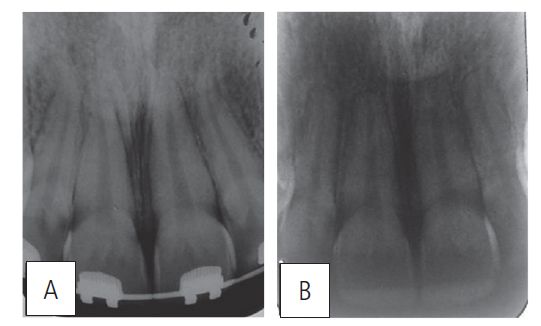 Figure 11: Maxillary incisors periapical (A) before intrusion; (B) after treatment