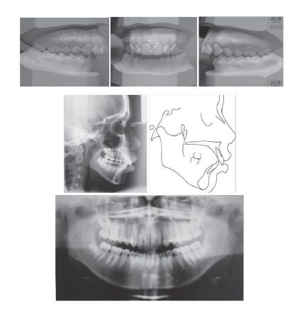 Figure 2: Pretreatment study casts, cephalogram, cephalometric tracing, and panoramic radiograph