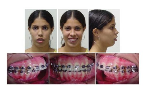 Figure 3: Photographs before extraction of maxillary first premolars