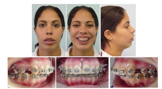 Figure 4: Photographs after premolar extractions, during anterior intrusion and en masse retraction