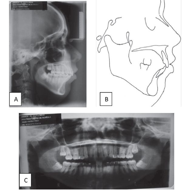 Figure 7: (A) post-treatment cephalogram, (B) cephalometric tracing, and (C) panoramic radiograph