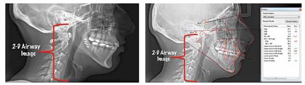 Figure 11: Post-surgical ceph; Figure 12: Post-surgical cephalometric values
