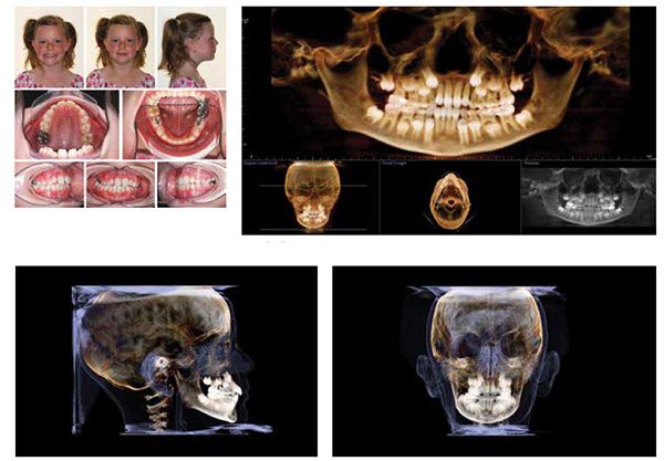Figure 1: Diagnostic photos of a 8-year 5-month-old female with a functional facial asymmetry resulting in a unilateral right posterior crossbite; Figure 2: Initial panoramic CBCT image acquired by an i-CAT Next Generation scanner; Figure 3: Diagnostic lateral CBCT image; Figure 4: Initial frontal CBCT image with right posterior crossbite and facial asymmetry