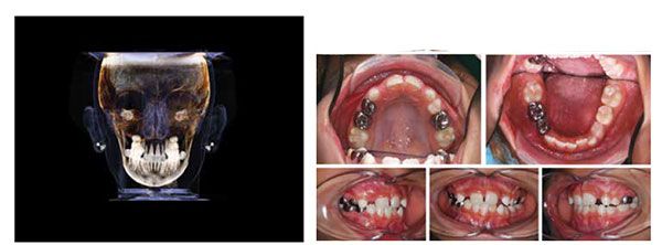 Figure 10: Frontal CBCT image at interim deband showing significant improvement in facial symmetry; Figure 11: Diagnostic photos of a 7-year 9-month-old female with hemifacial microsomia and right facial asymmetry