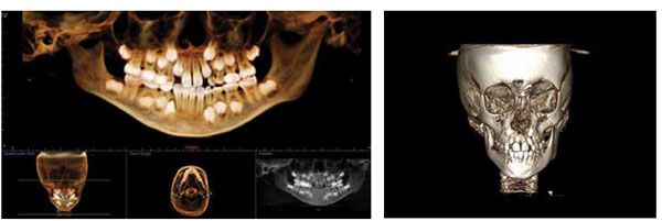 Figure 12: Panoramic CBCT imaging displaying significant crowding; Figure 13: Frontal CBCT imaging revealing a hypoplastic right maxilla and mandible