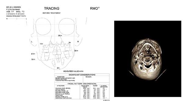 Figure 14: Frontal cephalometric analysis demonstrating canted occlusal plane and significant facial asymmetry; Figure 15: Axial CBCT image illustrating the difference in the size and shape of the inferior borders of the mandible