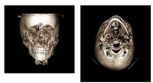 Figure 18: Frontal CBCT image at interim deband demonstrating improvement in facial symmetry with early interceptive treatment; Figure 19: Axial image at interim deband