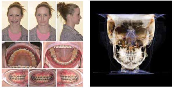 Figure 25: Post-surgical photos reveal significantly improved facial symmetry; Figure 26: Post-surgical CBCT frontal image demonstrating significantly improved skeletal symmetry