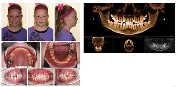 Figure 8: Interim deband photos demonstrating correction of posterior crossbite and functional facial asymmetry; Figure 9: Panoramic CBCT image at interim deband demonstrating reduction in dental crowding