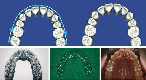 Figure 13: Just-in-time Essix® retainer for the upper arch created from the patient’s therapeutic model. The aligner was fabricated in the practice, and the fabrication of the hard model was outsourced to a remote laboratory