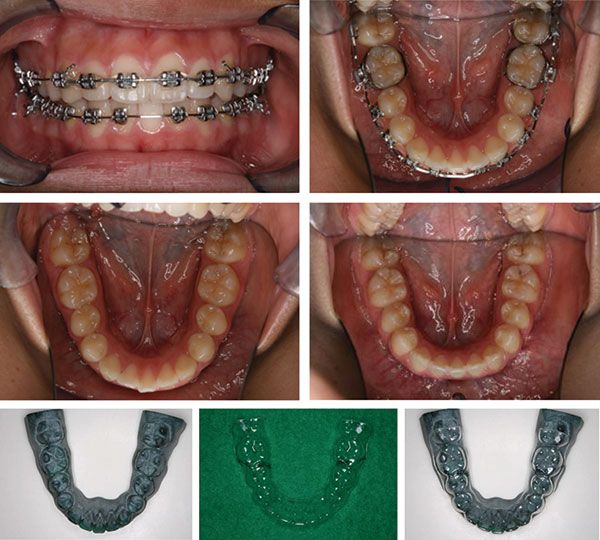 Figure 14: Note bracket loss on the lower left lateral incisor. The tooth rotation was corrected with an aligner rather thanrebonding the bracket. Note the aligner was fabricated from the patient’s virtual target setup; therefore, no additional scans or setups were required